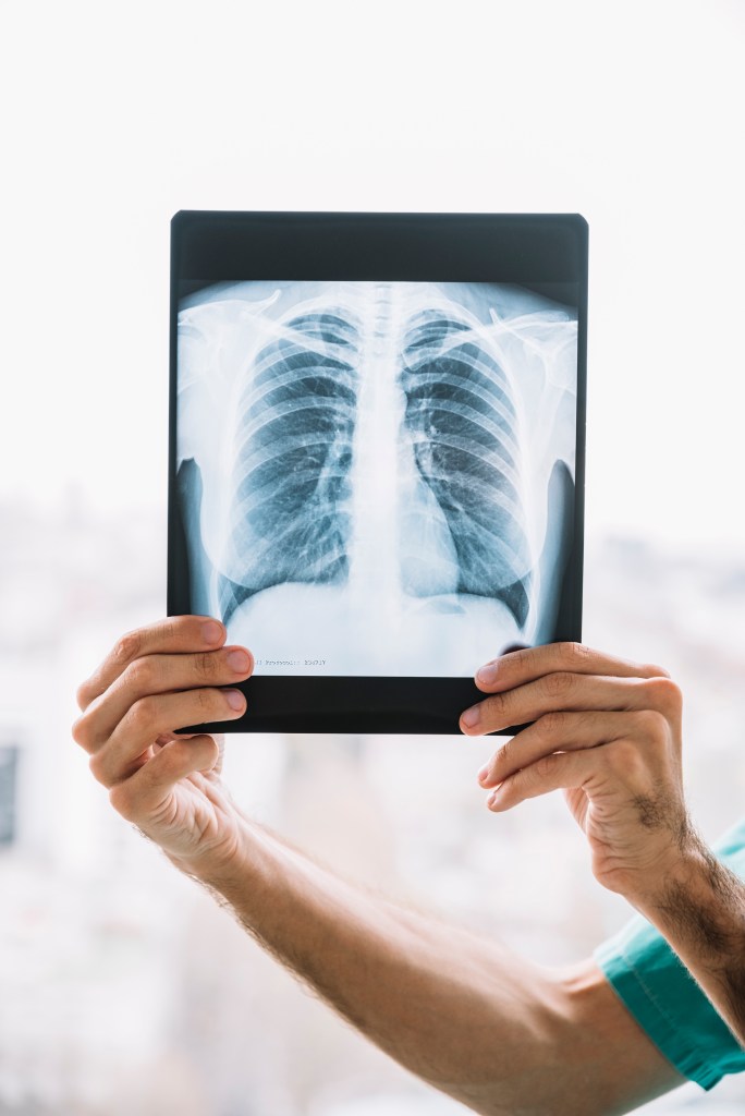 Qué es el cáncer de pulmón? - MSD Colombia