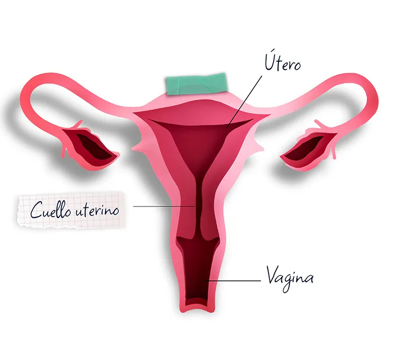 ¿Qué es el cáncer de cuello uterino?
